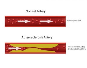 preventing-heart-attacks-plaque-buildup