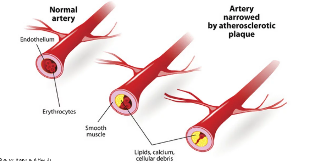 Coronary Calcium Scan Manhattan Cardiology