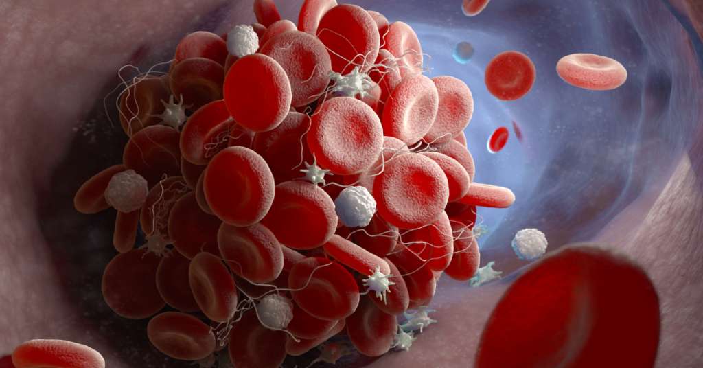 Blood Clotting Manhattan Cardiology