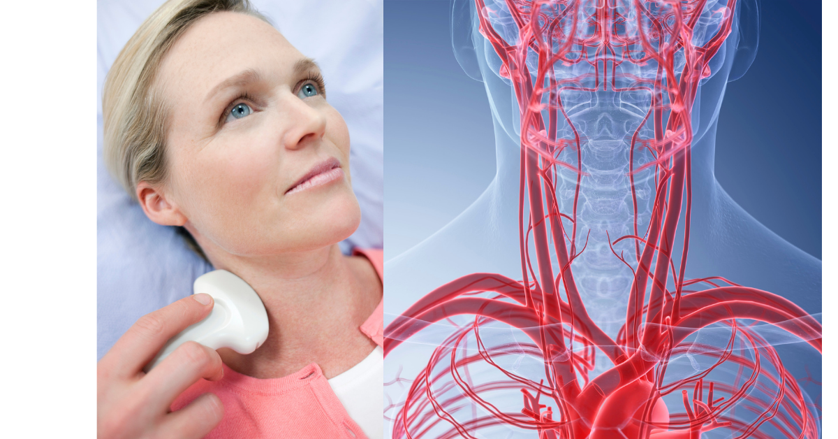 carotid artery duplex scan