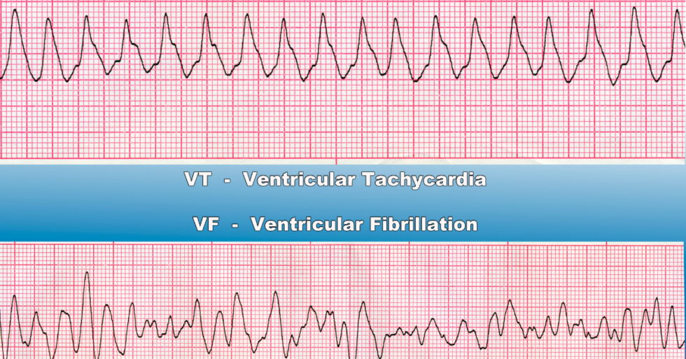 Tachycardia Manhattan Cardiology