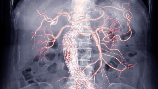 Aneurysms Can Happen In Your Abdomen?