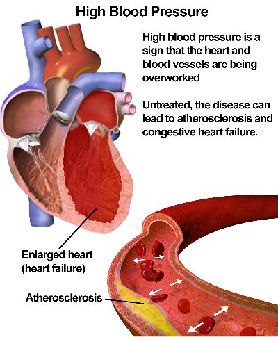 Medications for Congestive Heart Failure