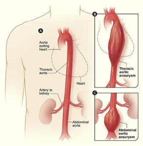 Aortic Aneurysm Screening