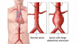 enlarged abdominal aortic aneurysm