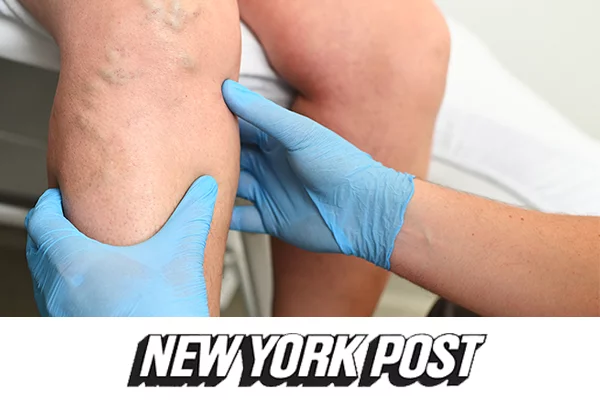 spider veins, vericose veins