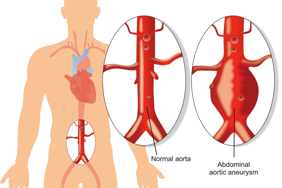 Abdominal Aortic Aneurysm