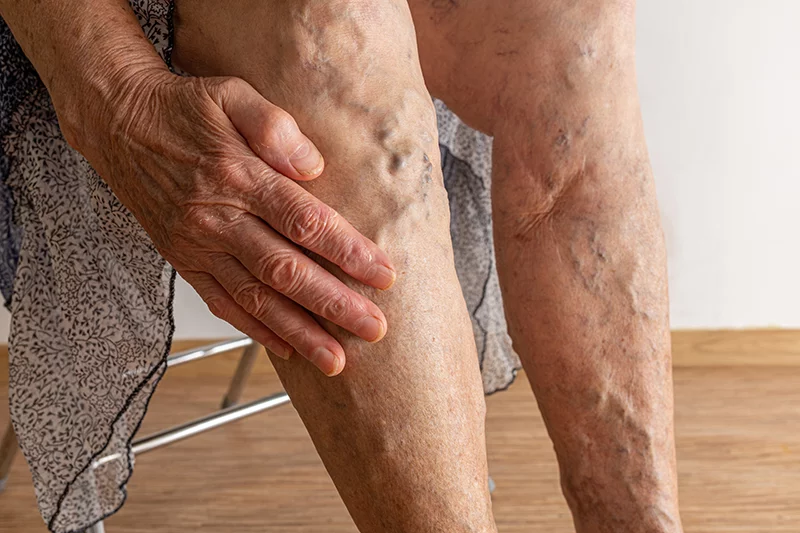 Leg Veins