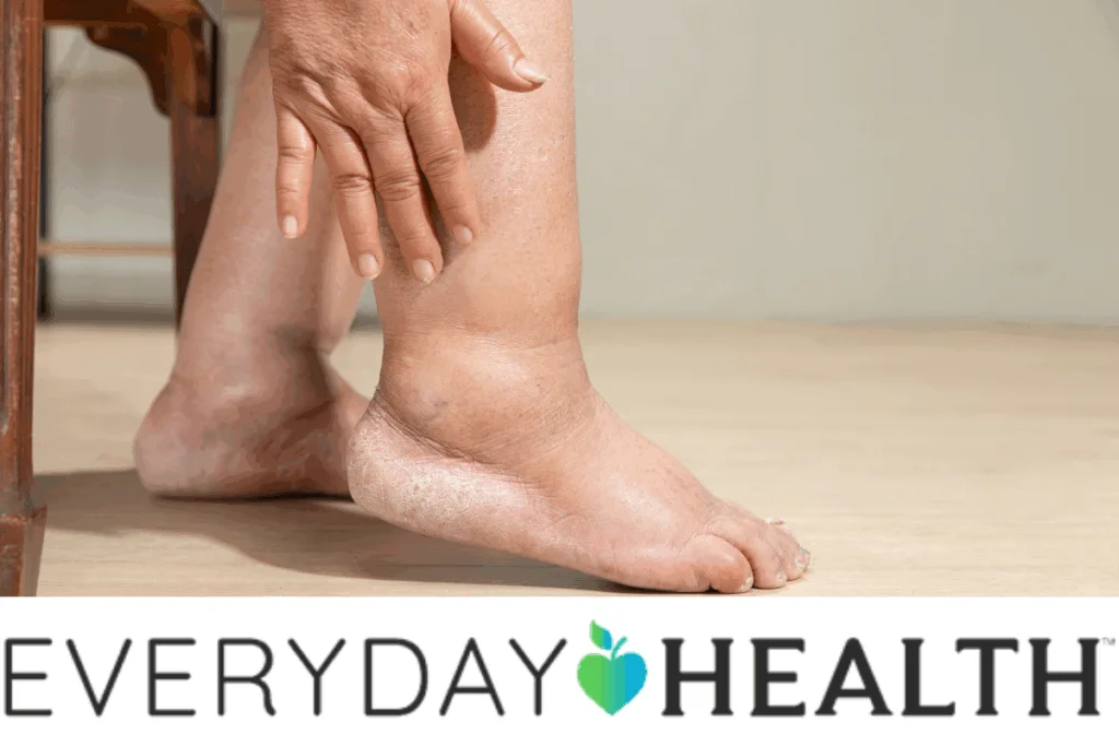 How to Prevent and Manage Swelling With ATTR-CM