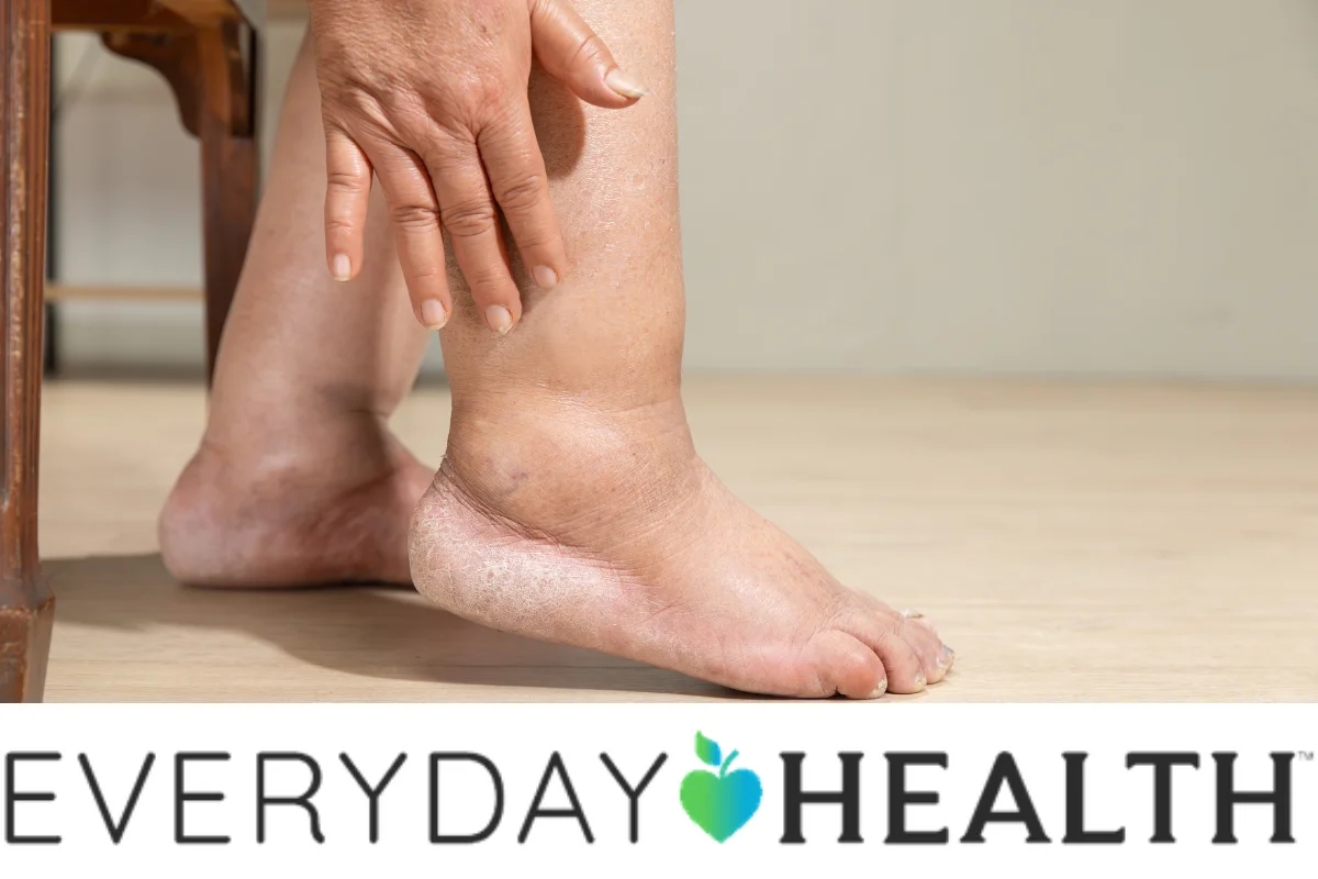 How to Prevent and Manage Swelling With ATTR-CM